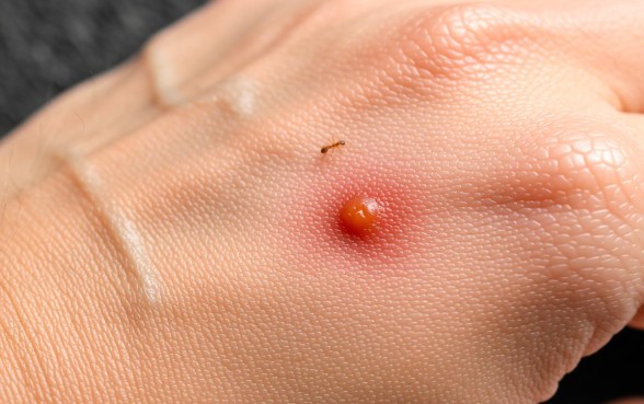 像蚂蚁咬的口子是什么病症